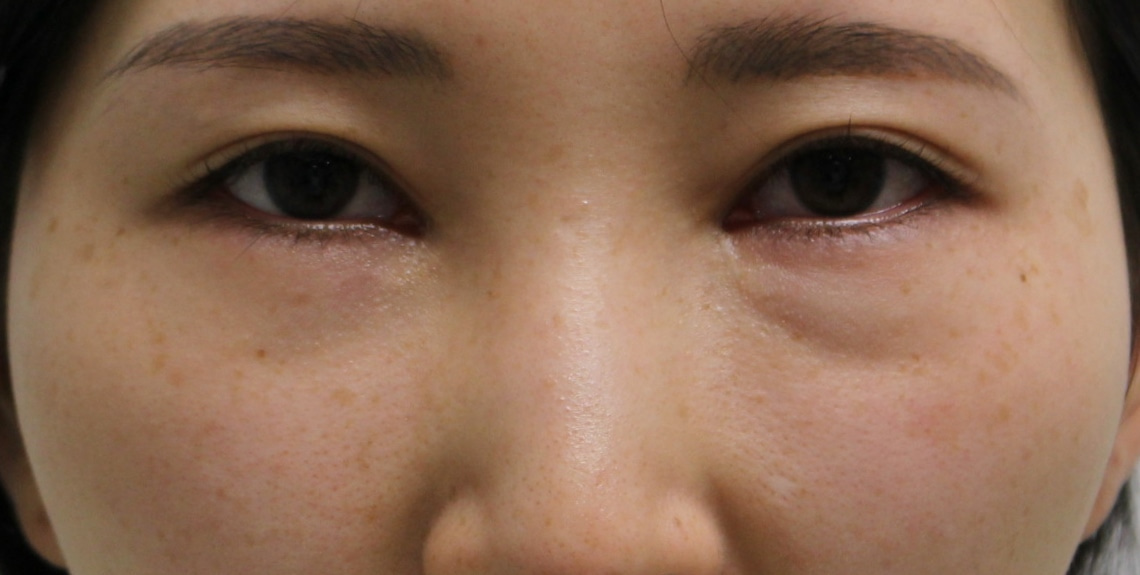 【他院修正】★297　27歳女性　経結膜脱脂術+眼窩脂肪注入