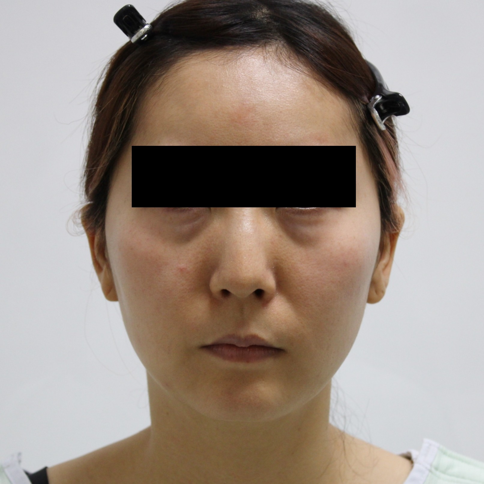 【切らないフェイスリフト】★176　34歳女性　頬アゴ下脂肪吸引+経結膜脱脂術+脂肪注入