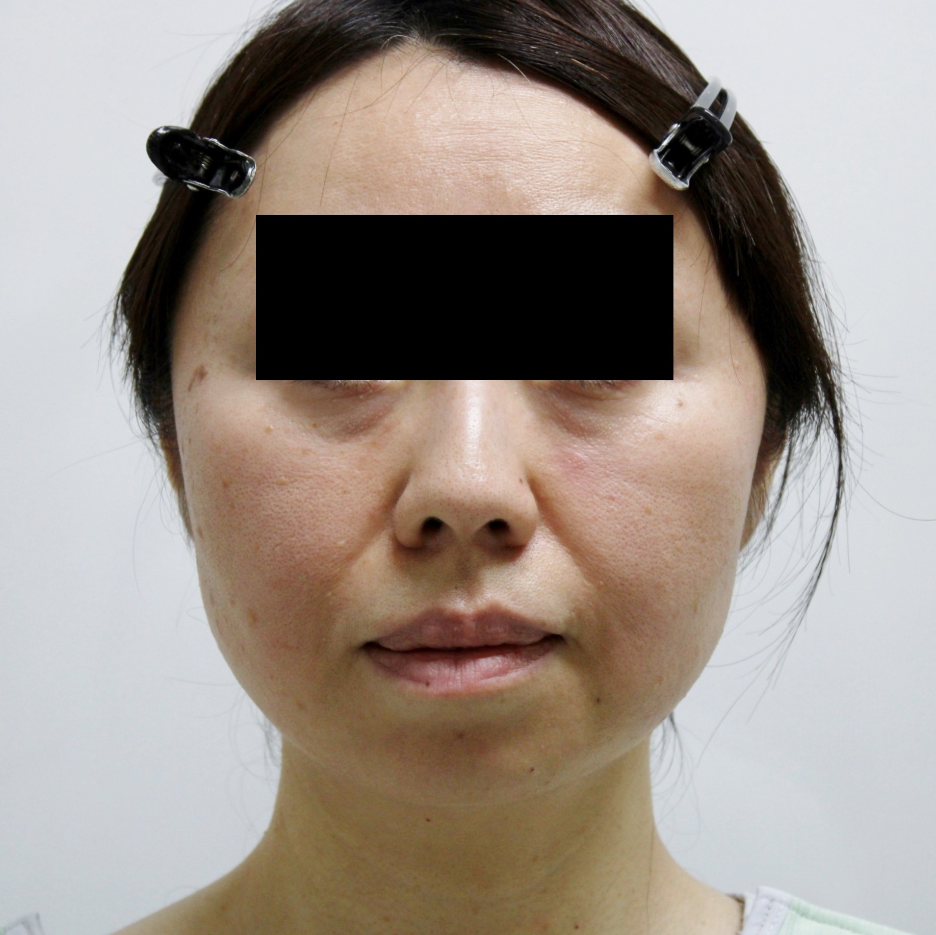 【切らないフェイスリフト】★177　46歳女性　頬アゴ下脂肪吸引+経結膜脱脂術+脂肪注入