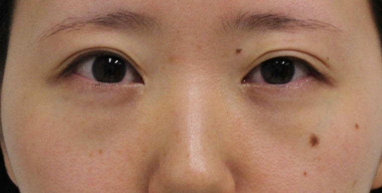 ★303　27歳女性　くま治療　経結膜脱脂術+眼窩脂肪注入