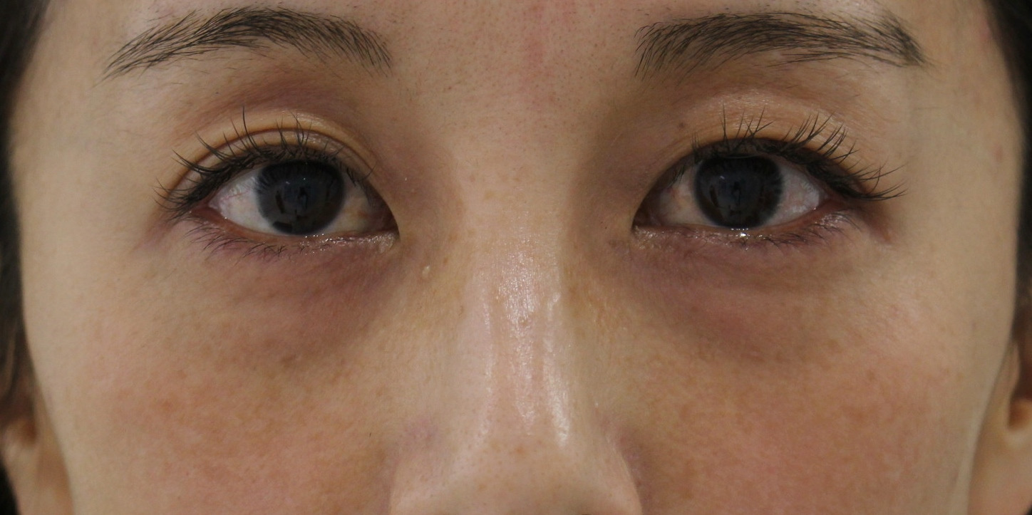 ★304　42歳女性　経結膜脱脂術+眼窩脂肪注入　くま治療