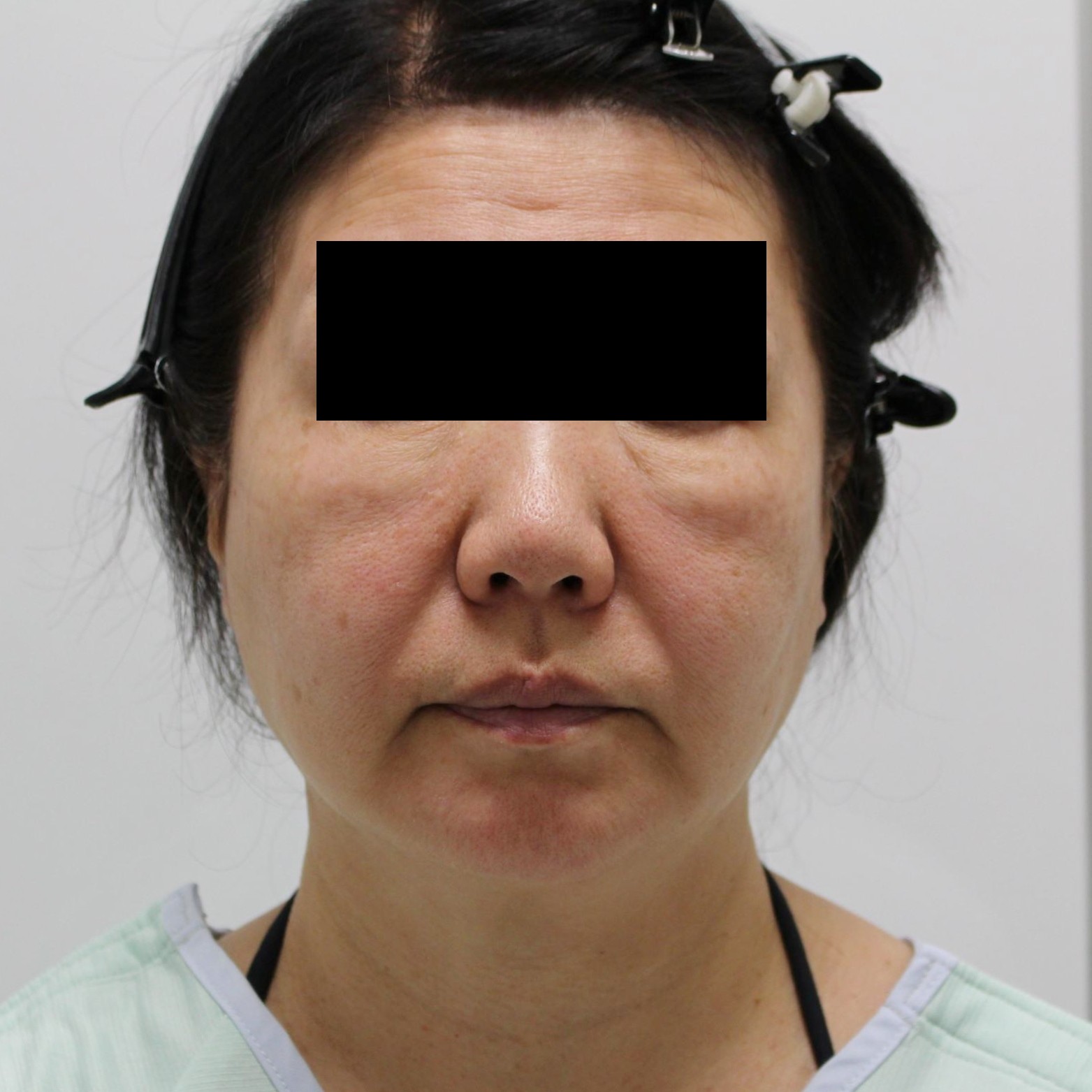 【切らないフェイスリフト術後1.5年】★135-2 60歳女性　頬顎下脂肪吸引+脂肪注入　