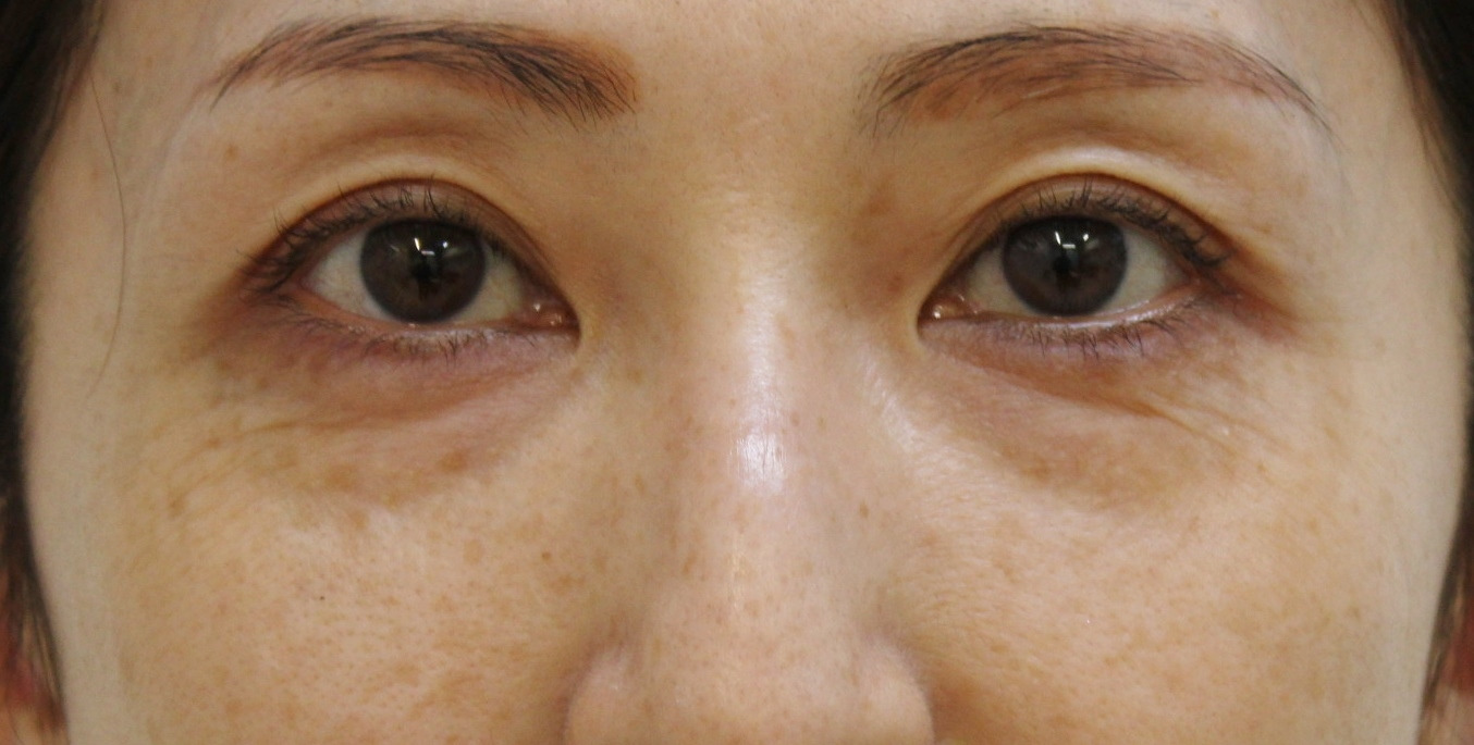 ★305　43歳女性　経結膜脱脂術+眼窩脂肪注入　くま治療