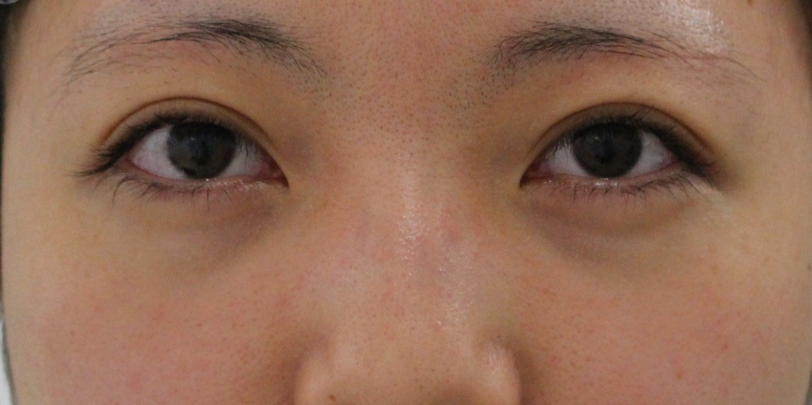 ★307　くま治療　22歳女性　経結膜脱脂術+眼窩脂肪注入