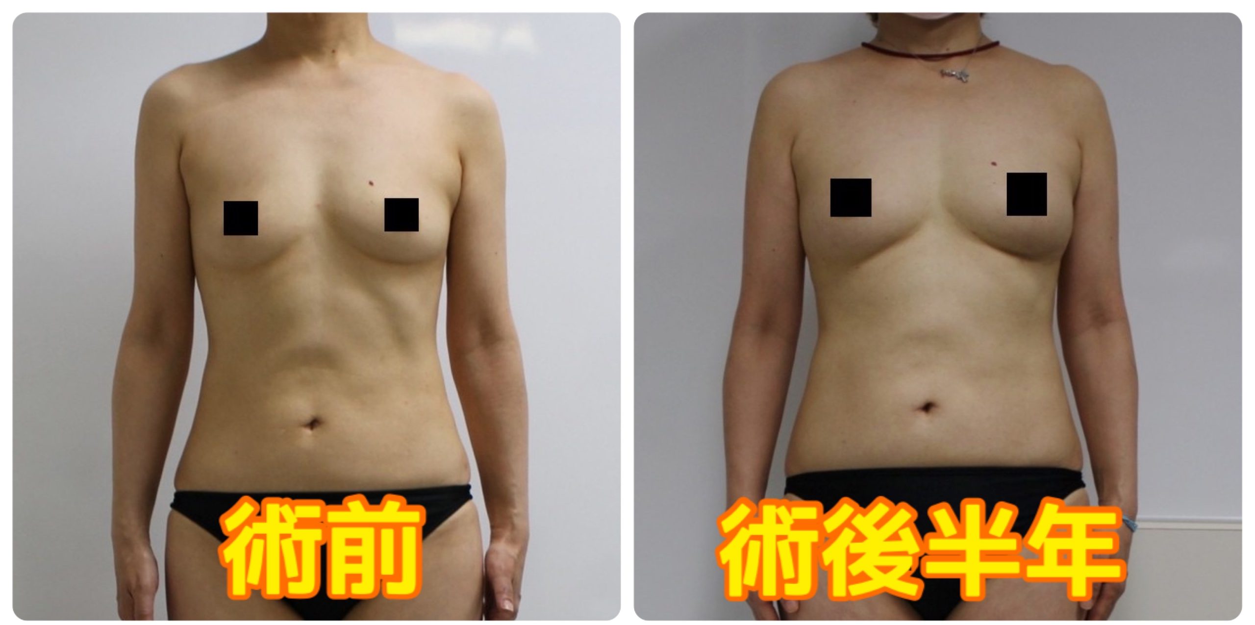 ★92　51歳女性　大腿臀部膝周りVASERアキーセル脂肪吸引+CRFバスト　半年まで