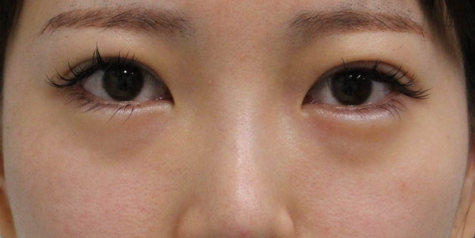 【他院涙袋HY失敗修正】★312　23歳女性　経結膜脱脂術+眼窩脂肪注入　クマ治療