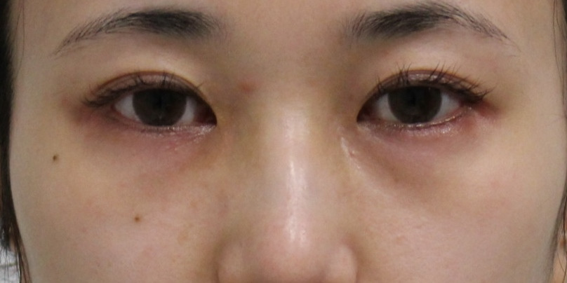 【失敗涙袋ヒアルロン酸溶解】★317　27歳女性 経結膜脱脂術+マイクロCRF　クマ治療