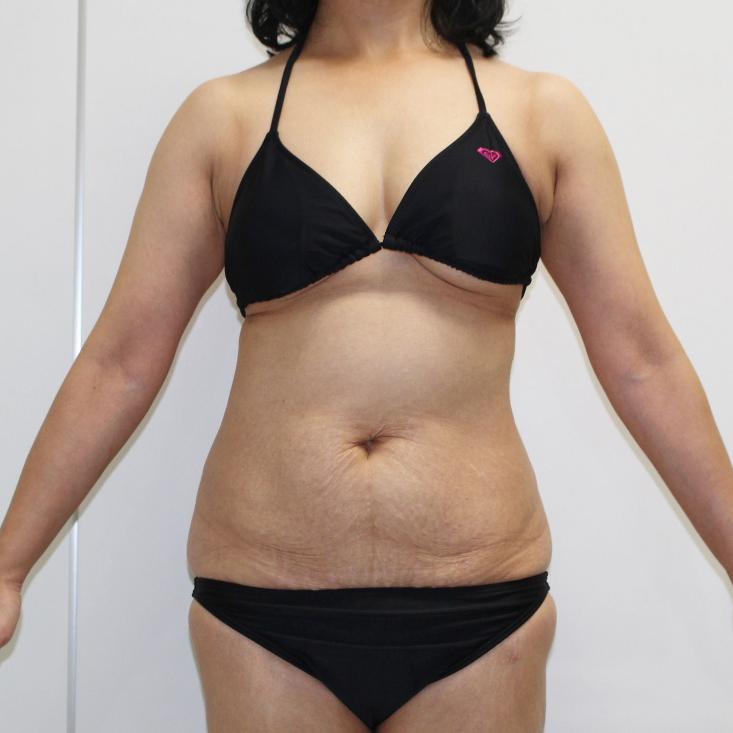 腹★77-2　50歳女性　腹部腰部VASERアキーセル脂肪吸引+切開によるたるみ取り