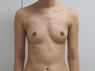 【1年後】★53　25歳女性　それほど太くない大腿臀部膝周りVASER+CRF豊胸　