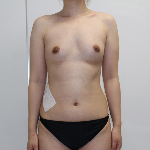 ★63　25歳女性　大腿臀部膝周り・上腕脇後ろ肩甲骨上VASER+CRFバスト　半年まで