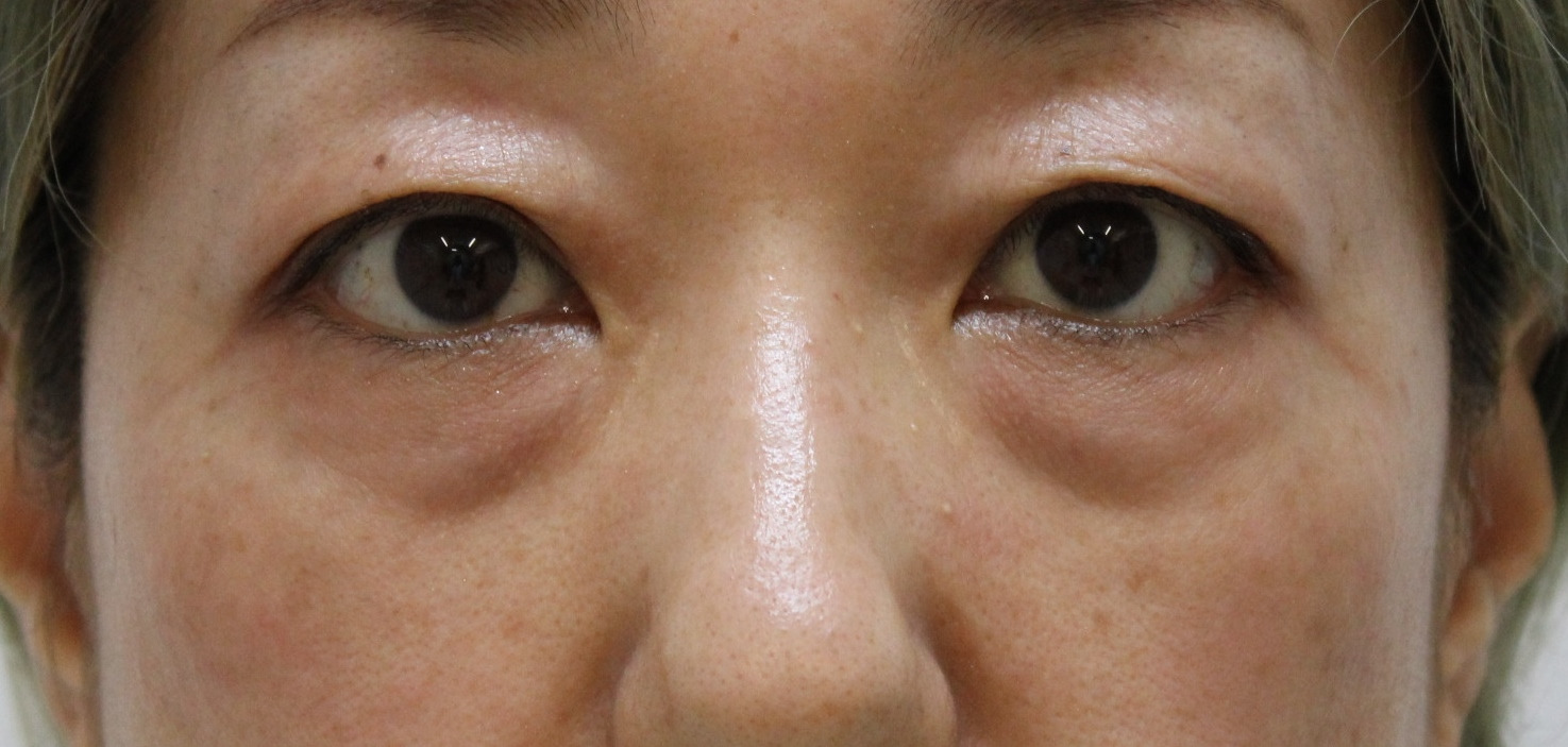 ★321　48歳女性　経結膜脱脂術+眼窩脂肪注入　クマ治療