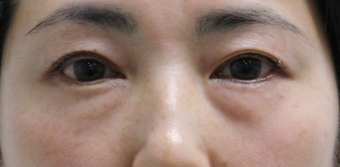 【隠れ涙袋】★323　44歳女性　経結膜脱脂術+眼窩脂肪注入　クマ治療