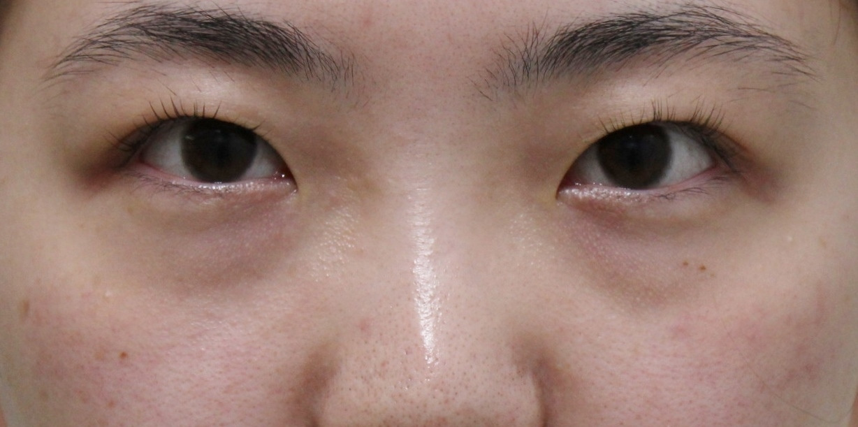 ★326　24歳女性　経結膜脱脂術+眼窩脂肪注入　クマ治療
