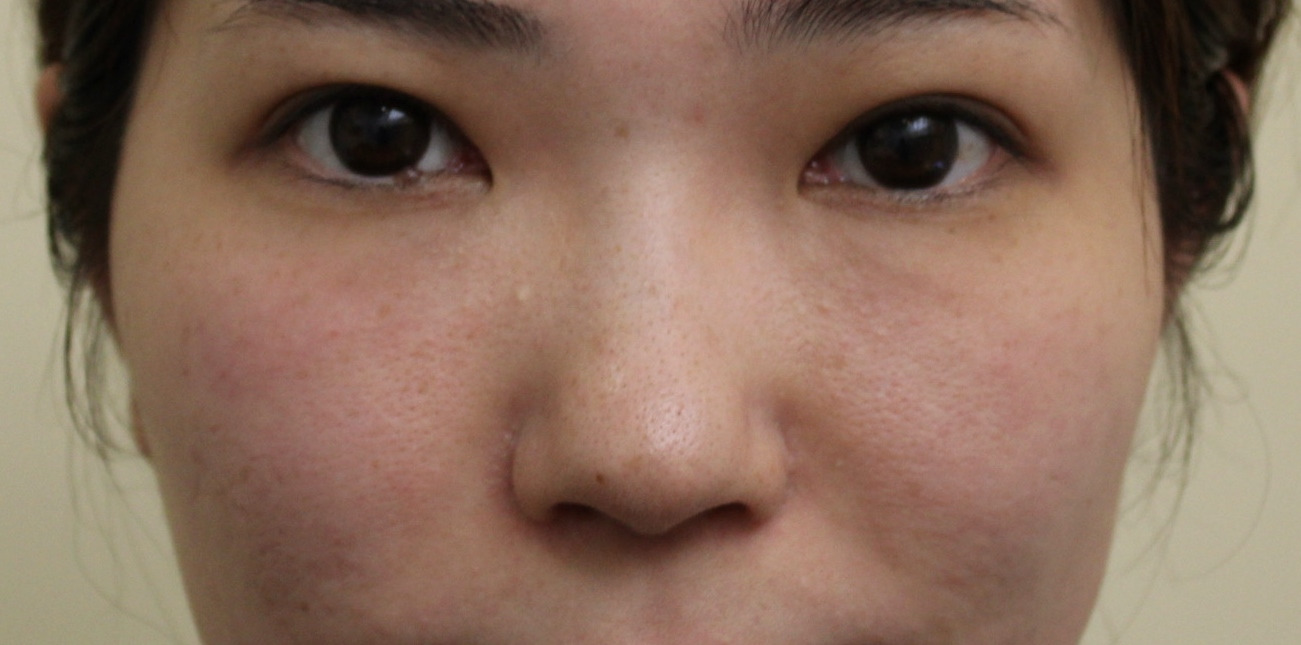 ★327 33歳女性 経結膜脱脂術+マイクロCRF 目の下・中顔面 マイクロカット脂肪除去