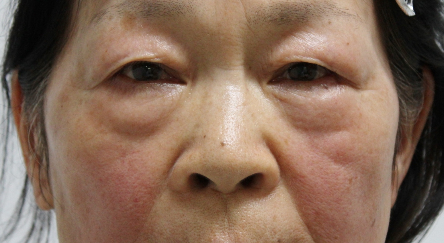 ★328 67歳女性　経結膜脱脂術+マイクロCRF（目の下・中顔面・ほうれい線）クマ治療