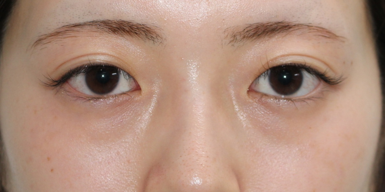 ★329　23歳女性　経結膜脱脂術+眼窩脂肪注入　クマ治療