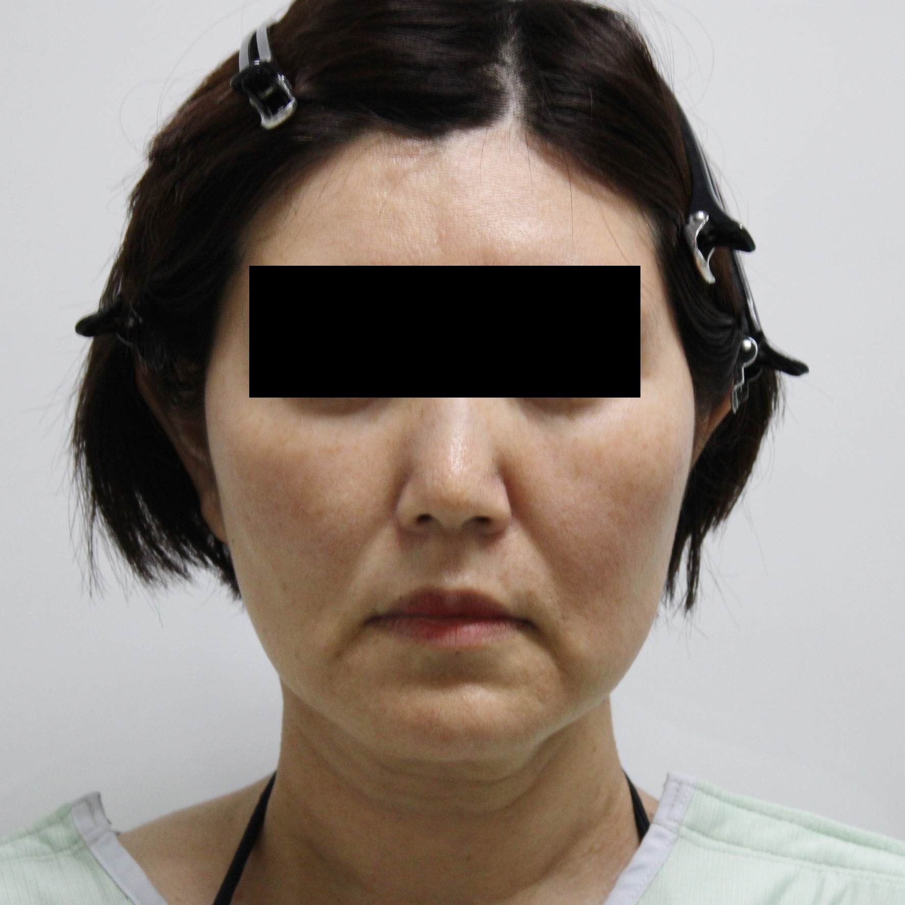 ★54　48歳女性　シグネチャーリフト+頬顎下脂肪吸引+脂肪注入