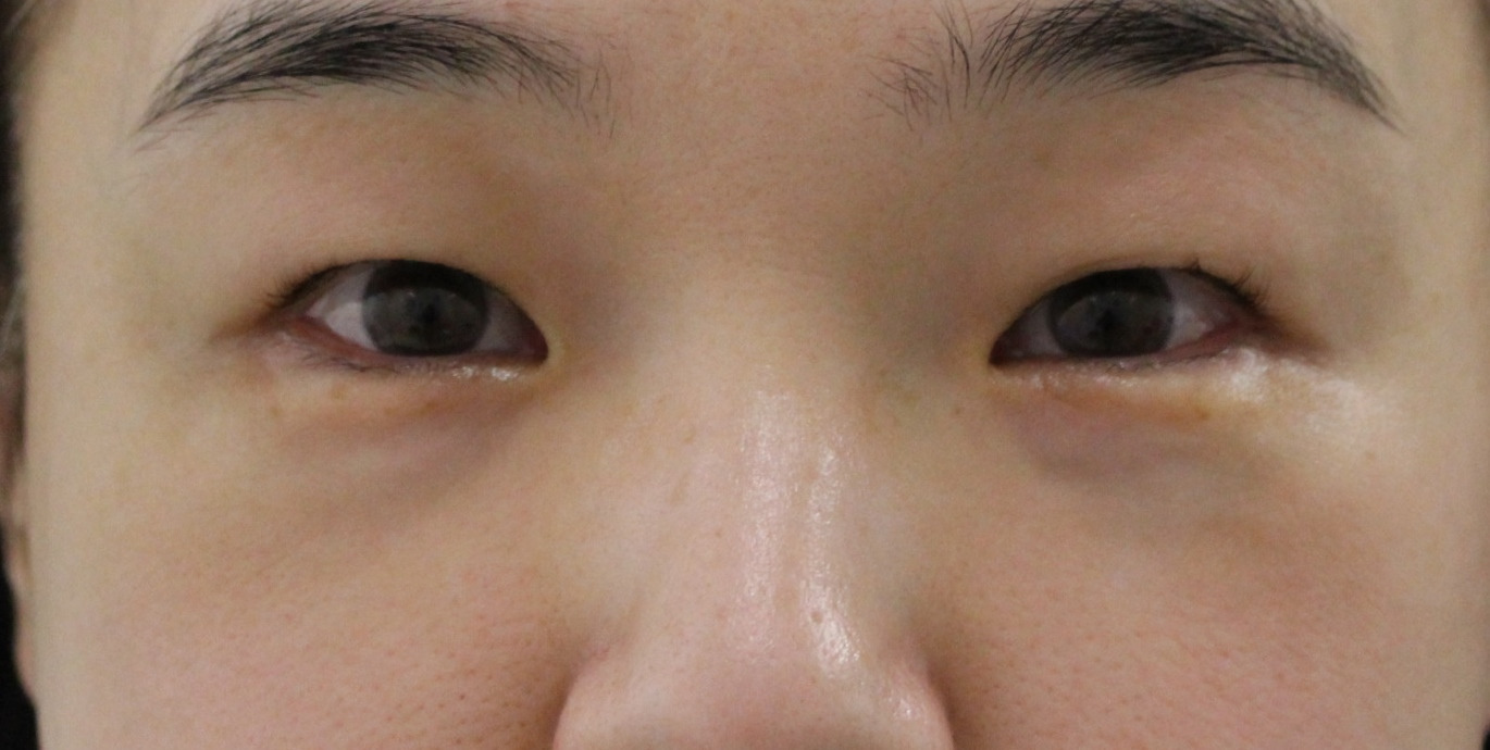 ★332　51歳女性　経結膜脱脂術+眼窩脂肪注入　クマ治療
