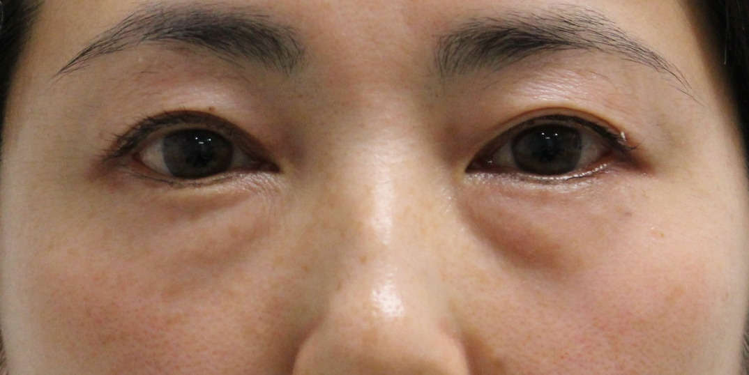 ★333　44歳女性　経結膜脱脂術+眼窩脂肪注入　クマ治療