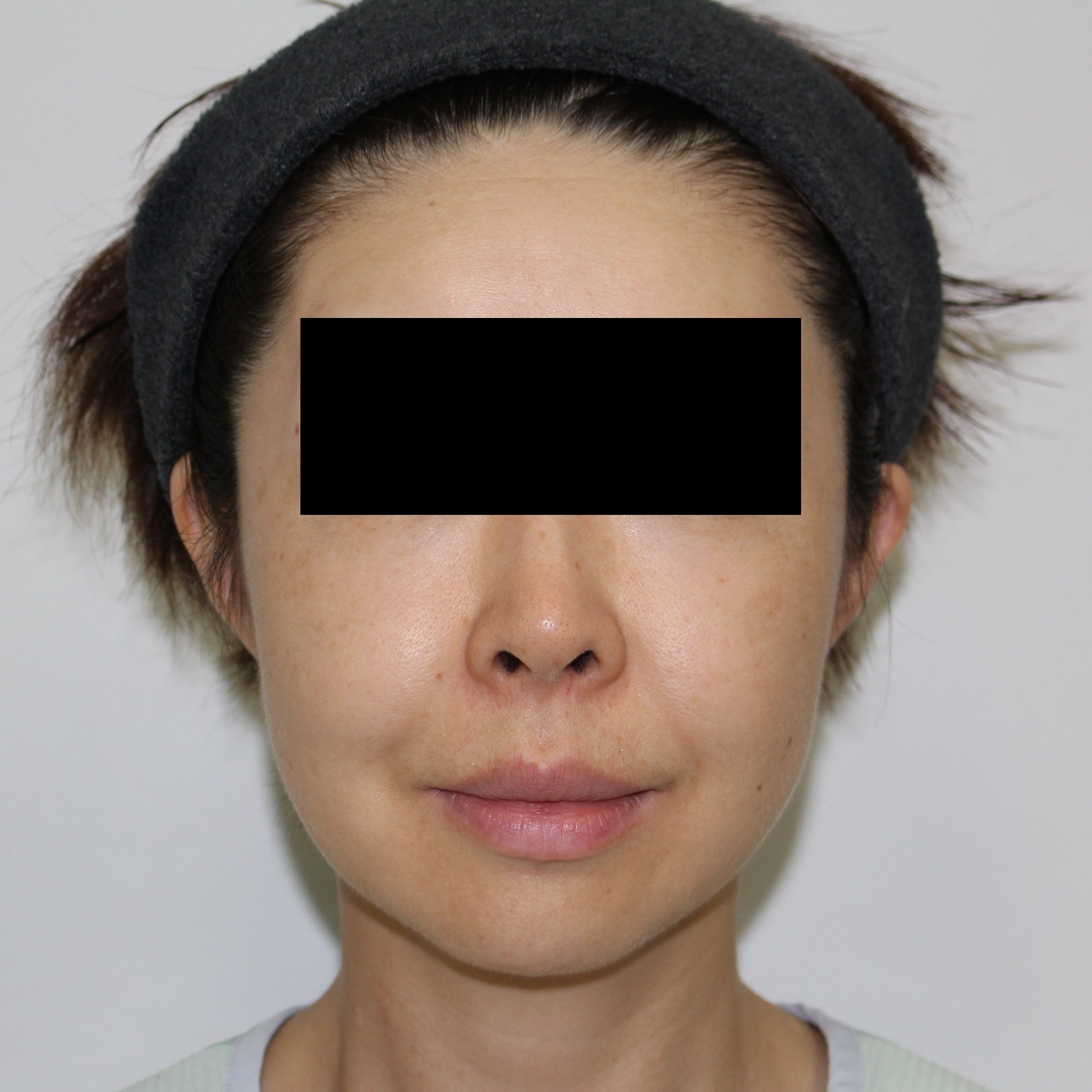 ★180　47歳女性　頬アゴ下VASERアキーセル+脂肪注入（+経結膜脱脂術）