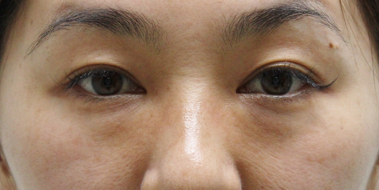 ★336　36歳女性　経結膜脱脂術+眼窩脂肪注入（クマ治療）