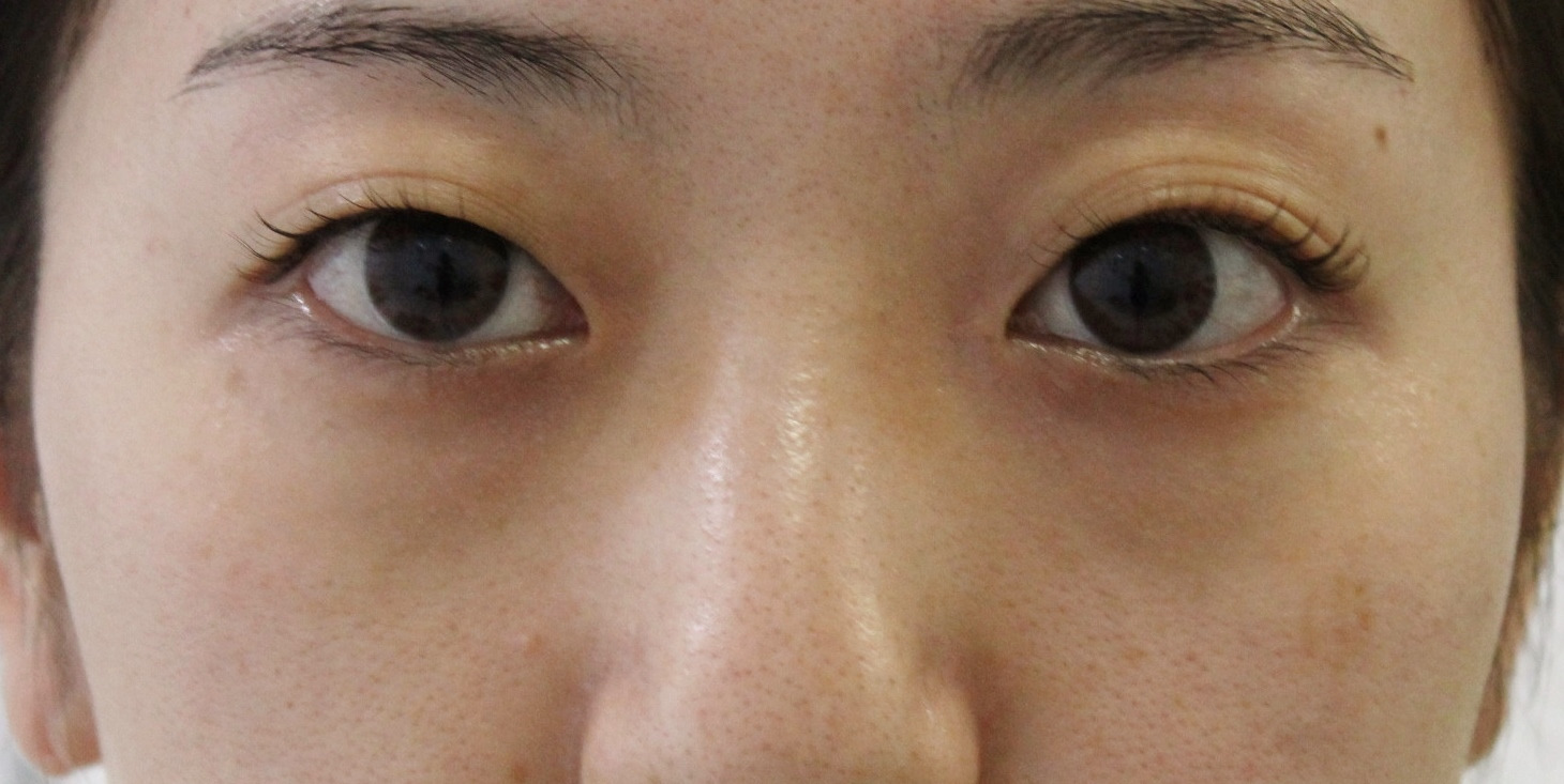 【隠れ涙袋】★339　28歳女性　経結膜脱脂+眼窩脂肪注入　クマ治療