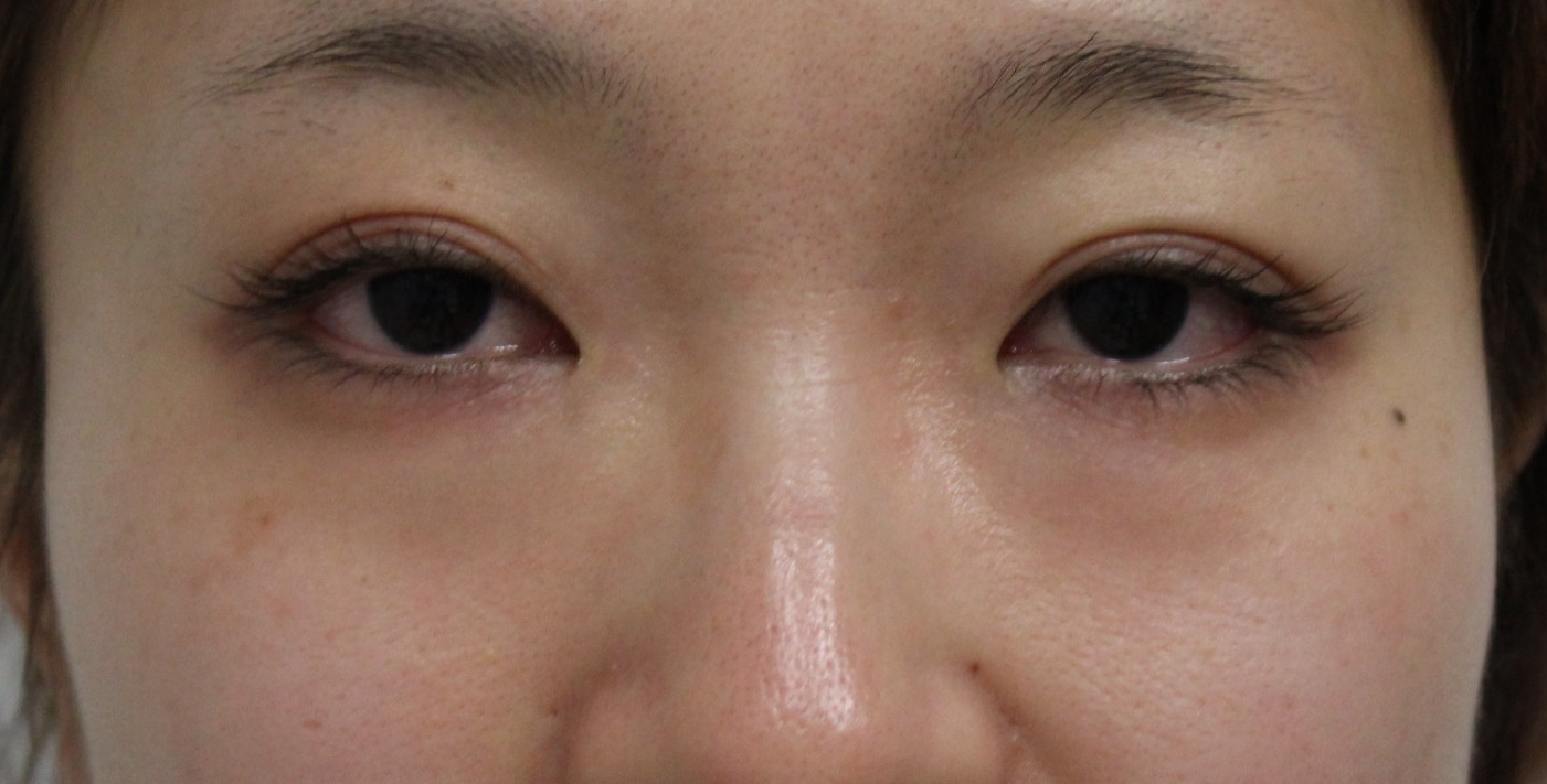 ★340　29歳女性　経結膜脱脂術+眼窩脂肪注入　クマ治療