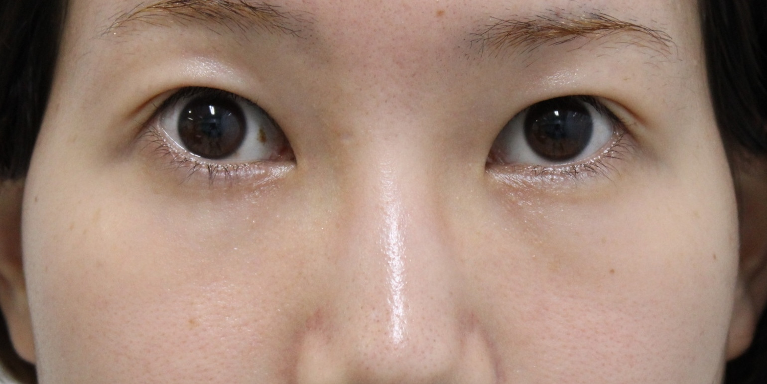 ★341　28歳女性　経結膜脱脂術+眼窩脂肪注入　クマ治療