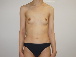 ☆52【痩せ体型】バッグインプラント拘縮　除去→大腿臀部脂肪吸引ピュアグラフト豊胸 バッグインプラント除去後1ヶ月