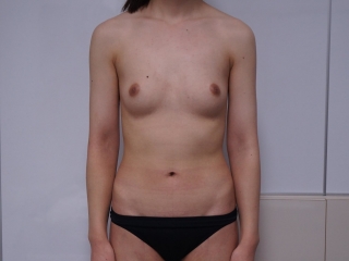 ☆52【痩せ体型】バッグインプラント拘縮　除去→大腿臀部脂肪吸引ピュアグラフト豊胸　ピュアグラフト豊胸後半年