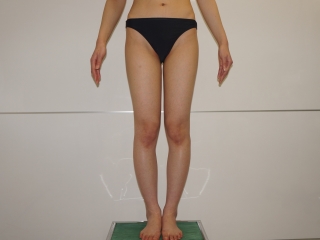 ☆52【痩せ体型】バッグインプラント拘縮　除去→大腿臀部脂肪吸引ピュアグラフト豊胸　術前 下半身