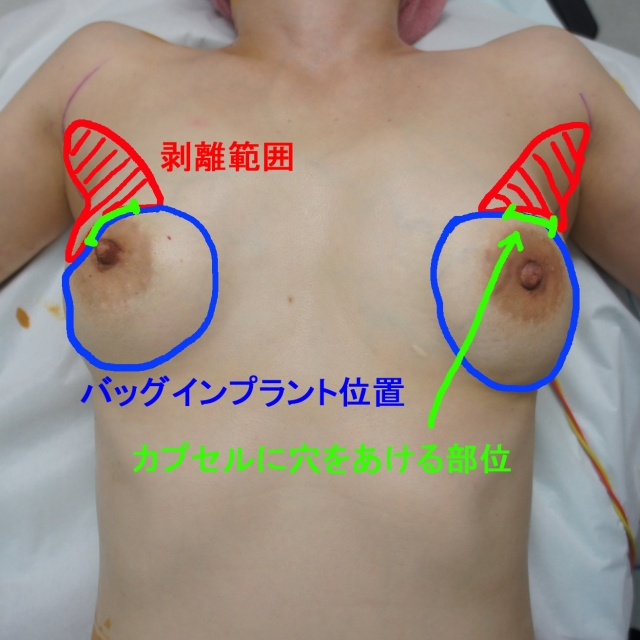 【6年後】★18　41歳女性　バッグインプラント除去+CRF豊胸　　（同時手術にしない理由） 術前デザイン
