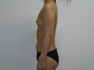 ★59【1年後】28歳女性　腹部腰部ベイザー脂肪吸引+CRFバスト 術前横