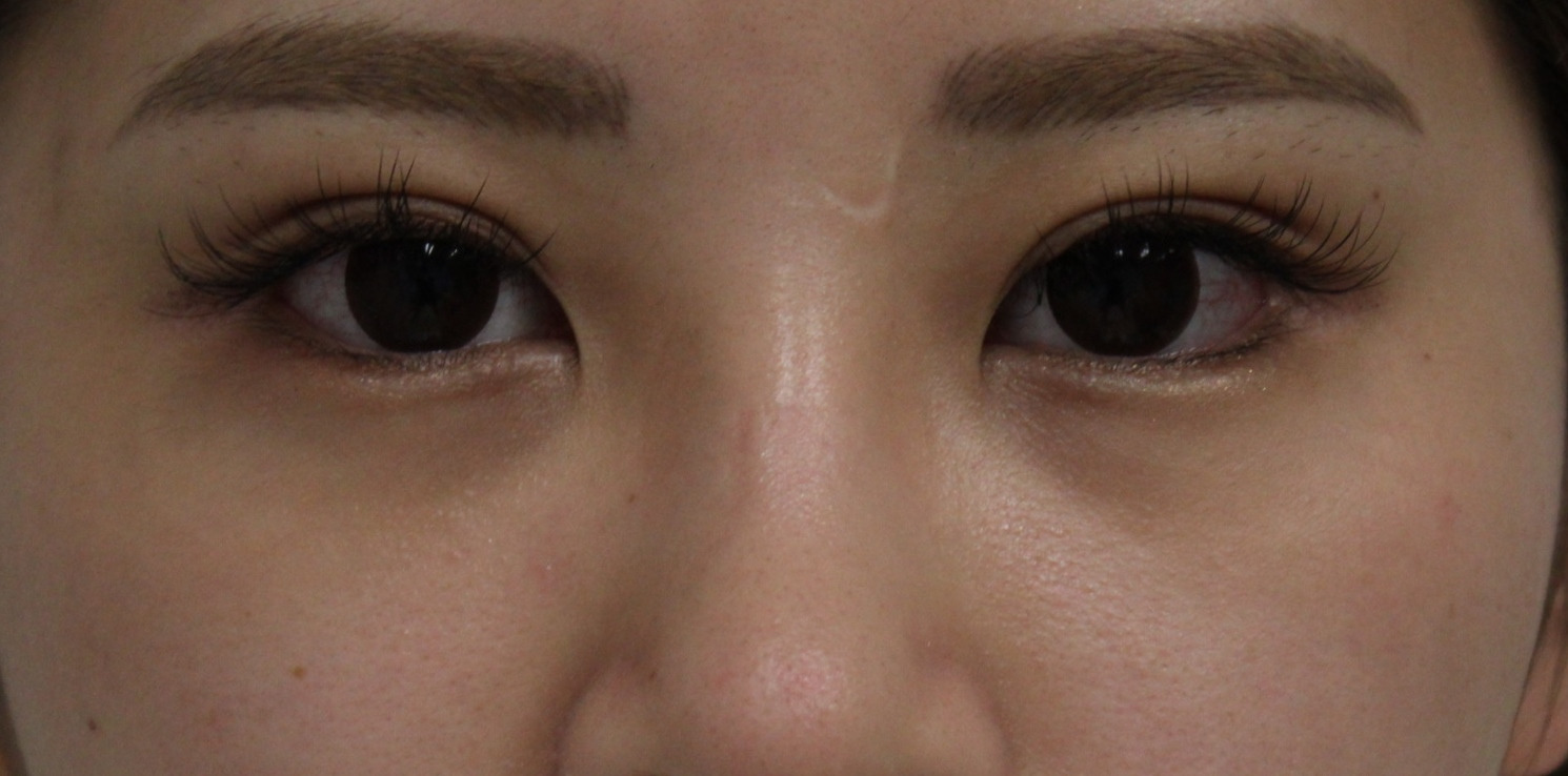 ★343　20歳女性　他院涙袋ヒアルロン酸溶解　経結膜脱脂術+眼窩脂肪注入（クマ治療）