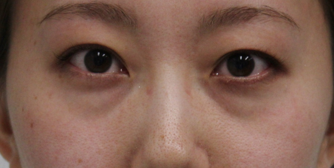 ★344　30歳女性　経結膜脱脂術+眼窩脂肪注入（クマ治療）