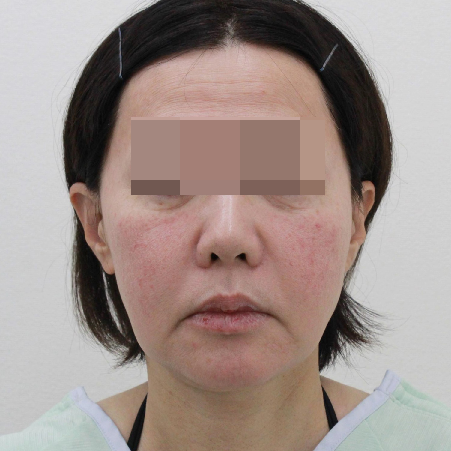 【切らないフェイスリフト】★187 56歳女性 頬顎下VASERアキーセル+マイクロCRF+ゴルゴ線治療