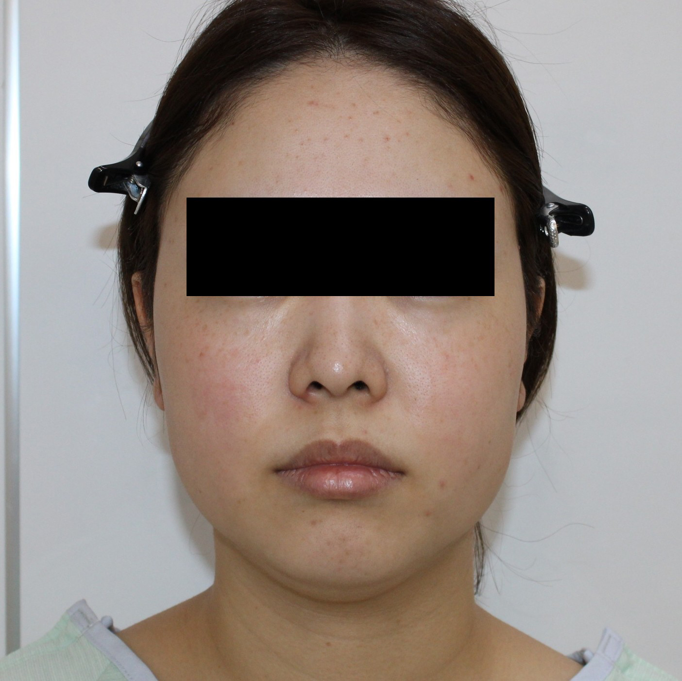 【劇的変化】★186 32歳女性　頬顎下VASERアキーセル +オトガイボリューマ