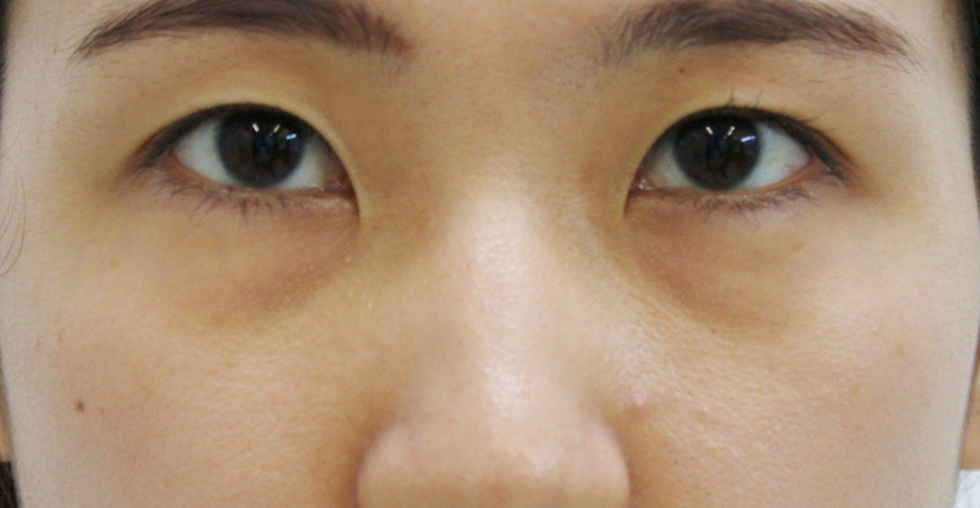 【隠れ涙袋】★352　25歳女性　経結膜脱脂術+眼窩脂肪注入　クマ治療