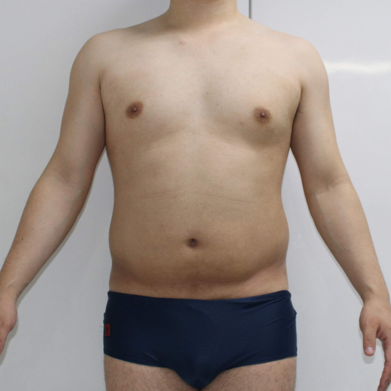 腹★80-2　34歳男性　腹部腰部ベイザーアキーセル脂肪吸引 1年後