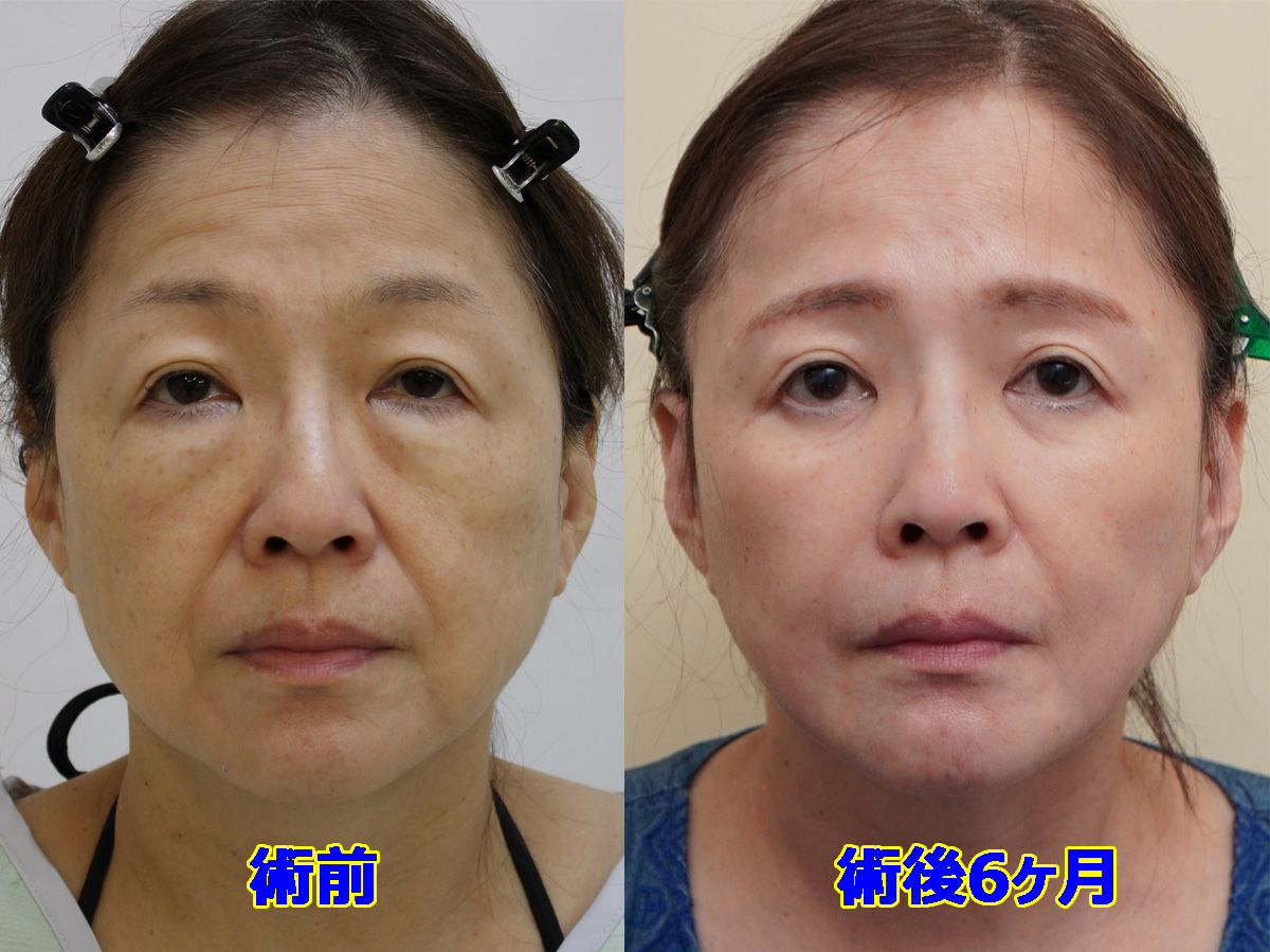 ★57 60歳女性 シグネチャーリフト +頬顎下VASERアキーセル+マイクロCRF +眉下切開+経結膜脱脂術