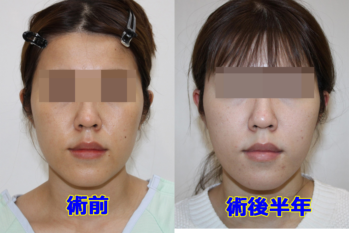 ★191　30歳女性　頬顎下VASERアキーセル+マイクロCRF（もともと脂肪少なめなタイプ）
