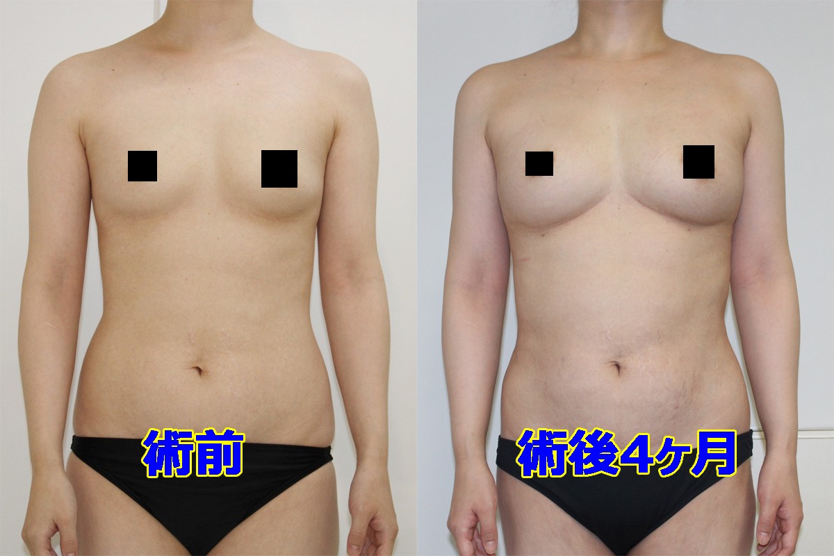 【B→F 4カップアップ】★94-2 36歳女性　腹腰VASERアキーセル+CRFバスト　（脂肪注入豊胸）
