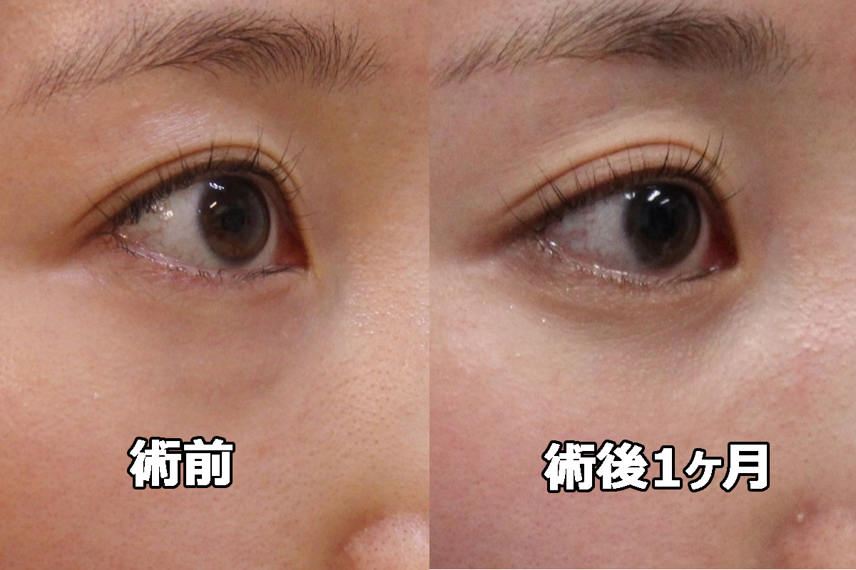 ★373 25歳女性 経結膜脱脂術+眼窩脂肪注入（クマ治療）キレイな目元に