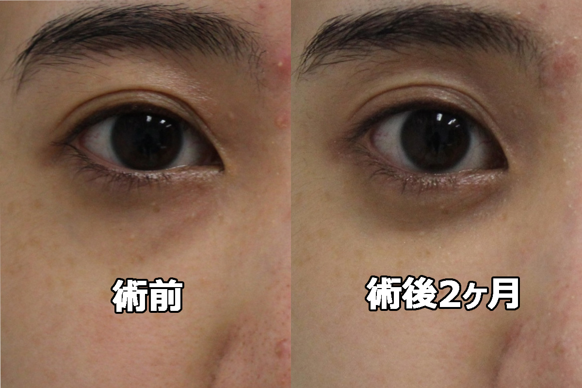 ★374 22歳女性 経結膜脱脂術+眼窩脂肪注入（クマ治療）一段上の美人目元へ