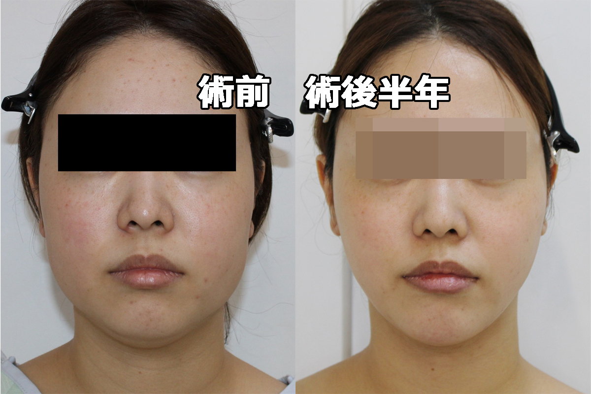 【劇的変化】★186-2 32歳女性　頬顎下VASERアキーセル +オトガイボリューマ 半年後