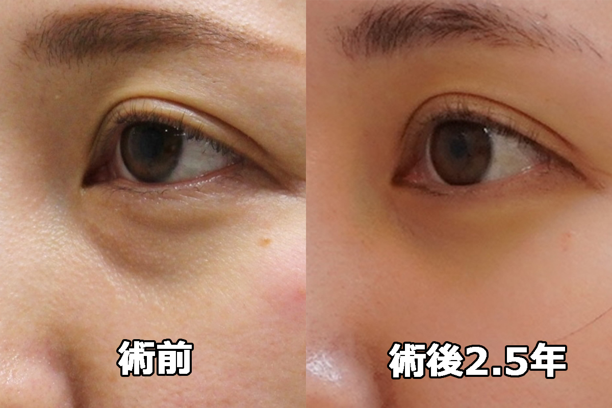【術後2.5年】★382-2 くま治療　39歳女性 経結膜脱脂術+眼窩脂肪注入