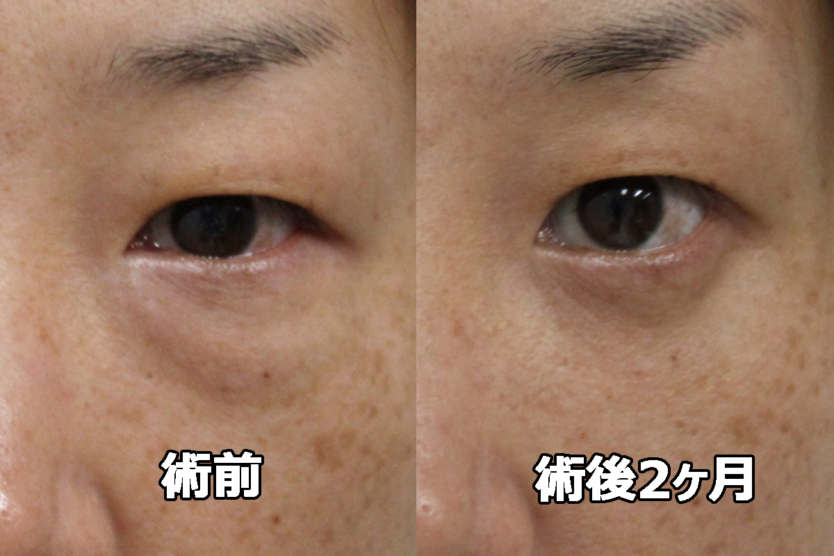 ★388 40歳女性 経結膜脱脂術+眼窩脂肪注入　再発症例　