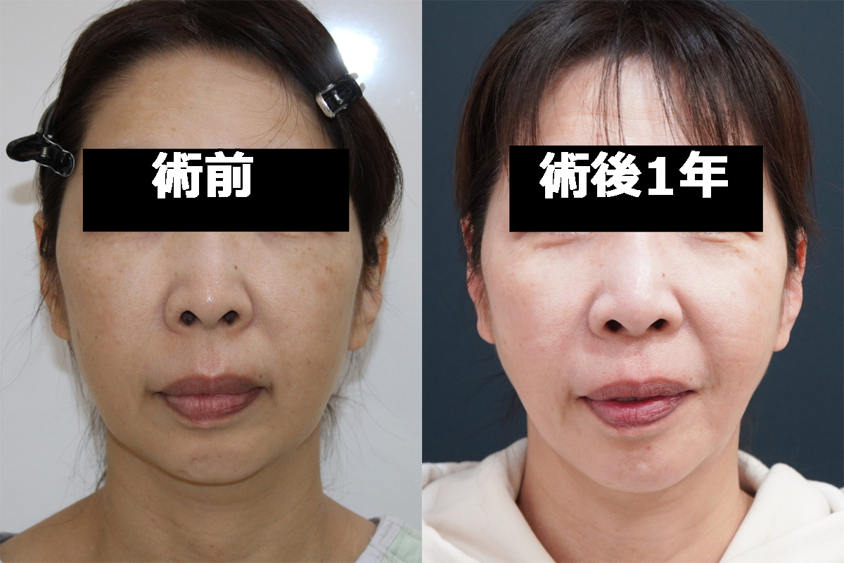 【切らないフェイスリフト　術後1年】★182-2　56歳女性　頬顎下VASERアキーセル+脂肪注入