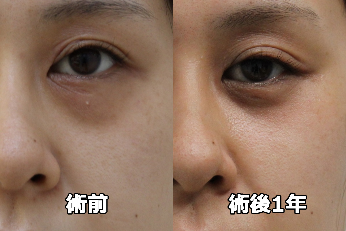 ★391　31歳女性　経結膜脱脂術+マイクロCRF（目の下・中顔面）　クマ治療