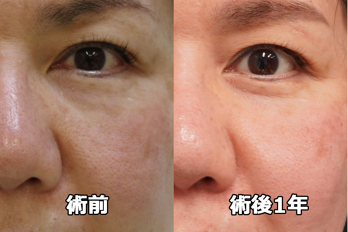 【術後1年】★355-2 52歳女性 経結膜脱脂術+マイクロCRF（+頬顎下脂肪吸引）